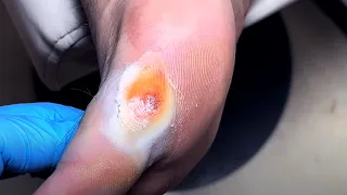 Infected large plantar warts on the soles of the feet【Foot Scalpel】