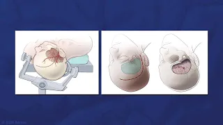 Microsurgical Clipping of an Anterior Communicating Artery Aneurysm