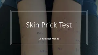 Skin Prick Test - Dr. Kaustubh Mohite