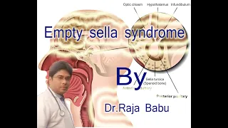 Endocrinology:Empty sella syndrome:Pituitary Disorder: By -Dr Raja Babu
