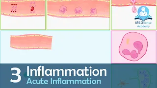 Acute Inflammation | Vascular & Cellular Events