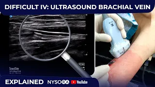 DIFFICULT IV: ULTRASOUND GUIDED BRACHIAL VEIN