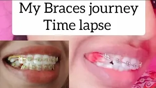 Full BRACES JOURNEY Time LAPSE/ ORTHODONTIC TREATMENT/ MY HAPPY JOURNEY