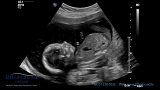 Scan of the Week: 18 Week Advanced Early Scan