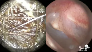 152 - Crystal Clear Eardrums Visible After WAXscope®️ Ear Wax Removal