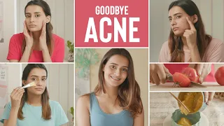 4 AMAZING WAYS to get rid of your ACNE for smooth, clear, GLOWING SKIN!