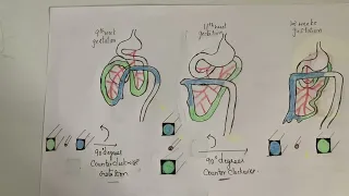 Midgut Rotation made easy