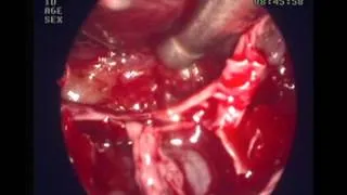 orbital haemangioma  endoscopic excision