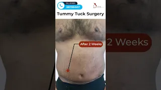 Male Tummy Tuck Surgery Result in 2023 | Tummy Tuck Before After | Divine Cosmetic Surgery