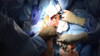 Multiple Osteochondral Allograft Transplantation with Concomitant Tibial Tubercle Osteotomy...