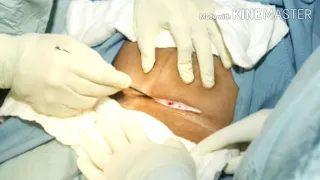 C section procedure in opration theater