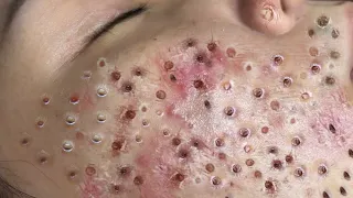 Loan Nguyen Acne Treatment 1733