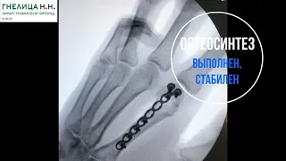 Перелом пястной кости (во время борьбы) - остеосинтез, травматолог Николай Николаевич Гнелица