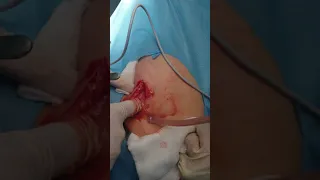 Abscess popping