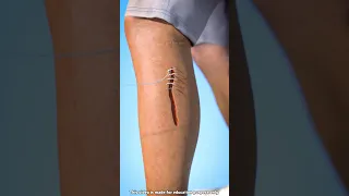 How Stitches Work In Body 🪡😯!!!