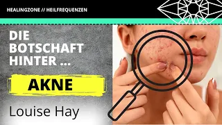 Louise Hay deutsch ‼️ AKNE – DAS möchte dir dein Unterbewusstsein damit sagen: