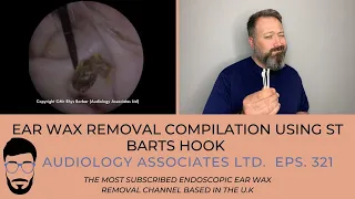 EAR WAX REMOVAL USING ST BARTS HOOK - EP 321