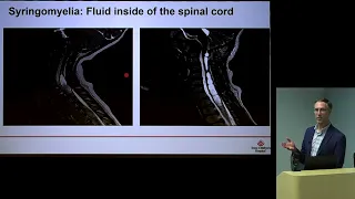 What to Know About Chiari 1 Malformation: What is Chiari and Why Do I Have Symptoms? feat. Dr. Bauer