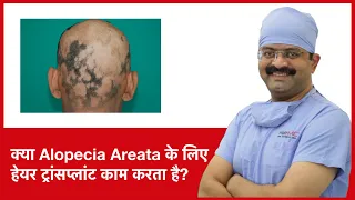 Does Hair Transplant Work For Alopecia Areata | HairMD, Pune | (In HINDI)