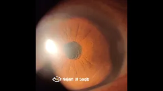 Dense Pupillary Membrane (Anterior Chamber Inflammation)  On Post-Cataract Surgery Day 1