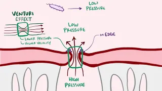 Endocarditis infective, libman sacks   causes, symptoms, treatment & pathology