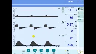 Understanding Mechanical Ventilation Scalars: Pressure-Time, Flow-Time, and Volume-Time Curves