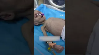 Malnourished Palestinian child receives medical treatment at Kamal Adwan Hospital