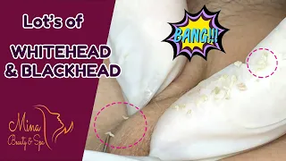 Removal BLACKHEADS and WHITEHEADS for 19 years old Man | Not Loan Nguy LALIT KASANA |