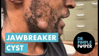 The Jawbreaker Cyst! Dr Pimple Popper Removes Cyst Intact!