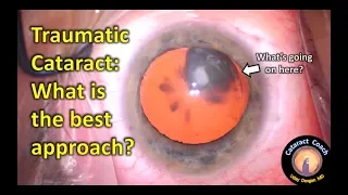 The approach to a Traumatic Cataract from a bungee cord injury to the eye