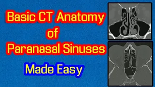 Basic CT Anatomy of Paranasal Sinuses, Made Easy