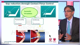 EHRA free webinar: Contact sensing for ablation: What have we learned and how to use it?