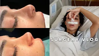 MY 3RD NOSE JOB | RHINOPLASTY RECOVERY & REVEAL