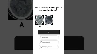 #NEUROQUIZ02 Which one is vasogenic edema? #shorts #short