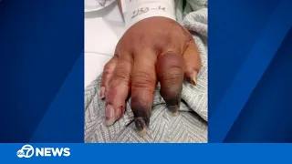 SF woman to have fingers amputated after nearly dying from COVID-19