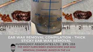 EAR WAX REMOVAL COMPILATION - THICK STICKY EAR WAX REMOVAL - EP 233