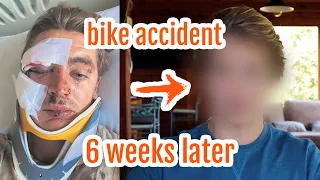 Face Reveal (6 weeks after my bike accident) + Recovery Protocol