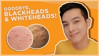 BEST SKINCARE for BLACKHEADS & WHITEHEADS! (OPEN & CLOSED COMEDONES) | Jan Angelo