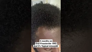 Finasteride WORKS! 5 months Finasteride transformation #finasteride #minoxidil #malepatternbaldness