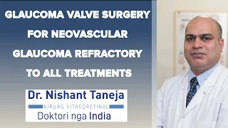 Glaucoma Valve Surgery for Neovascular Glaucoma Refractory to all treatments