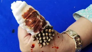 How to remove ticks from hand to be healthy #302