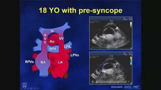 Adult Congenital Heart Disease: Anomalous Pulmonary Veins