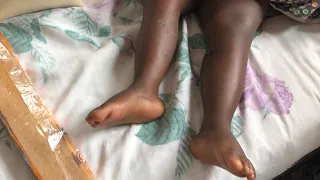 Does God heal this girl's leg? You be the judge.