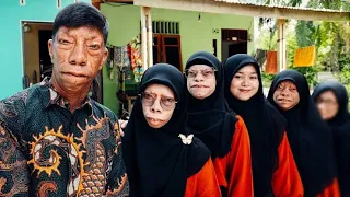 The family whose faces have changed shape | only 25 individuals out of 7 billion people in the world