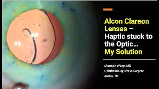 When the haptic sticks to the optic with Alcon Clareon lenses (PanOptix) – My solution.