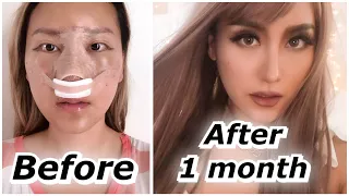 Rhinoplasty 1 month update BEFORE & AFTER | ID Hospital Surgery PART 2