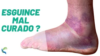 ANKLE SPRAIN 🦶 POORLY cured 😖 Exercises and tips Fisiolution