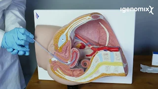 How to perform the endometrial biopsy for Igenomix´s ERA Test