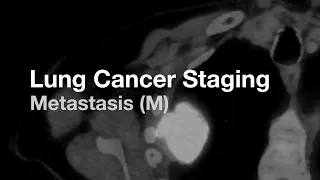 Lung Cancer Staging - Metastasis (M)