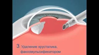 Операция по удалению катаракты — факоэмульсификация